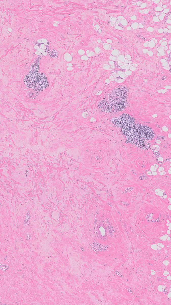 Charles Herndon (@drcyclopath) on Twitter photo Breast biopsy shows epithelioid cells, dense collagen, and lymphocytic aggregates. 
What could it be?π§π§
A) Myofibroblastoma
B) Fibroadenoma
C) Lymphocytic mastopathy
D) Fibromatosis
#BreastPath #Pathology #PathTwitter| 
π¬ learn.mghpathology.org/index.php/DZI1β¦ Breast biopsy shows epithelioid cells, dense collagen, and lymphocytic aggregates. 
What could it be?π§π§
A) Myofibroblastoma
B) Fibroadenoma
C) Lymphocytic mastopathy
D) Fibromatosis
#BreastPath #Pathology #PathTwitter| 
π¬ learn.mghpathology.org/index.php/DZI1β¦