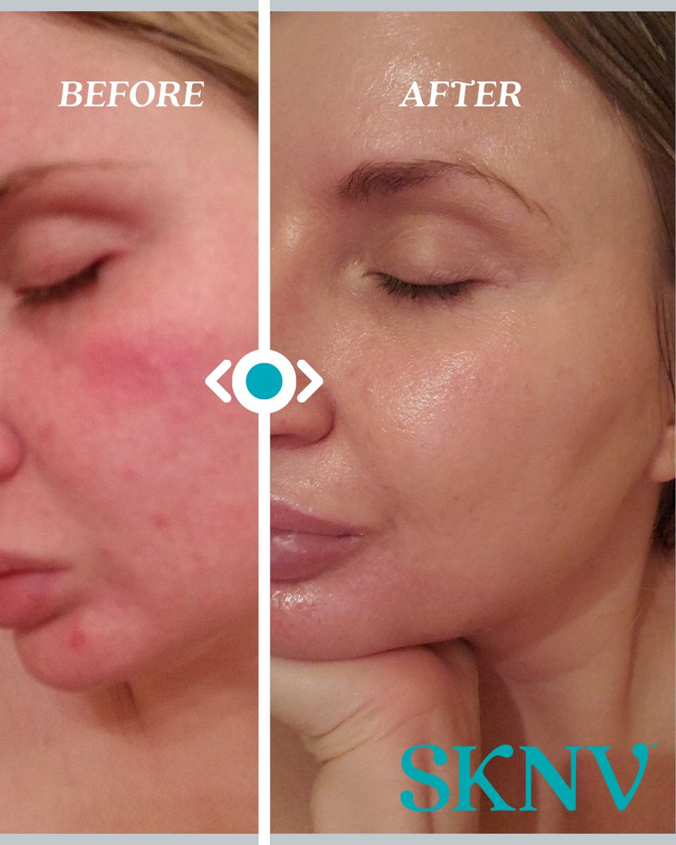 Real results. Real relief. 💙
This rosacea transformation is a reminder of what personalized dermatology can do. With the right customized Rx, clearer, calmer skin is possible.

#Rosacea #SKNVResults #CustomizedRx #SkinTransformation #BeforeAndAfter #DermatologyThatDelivers
