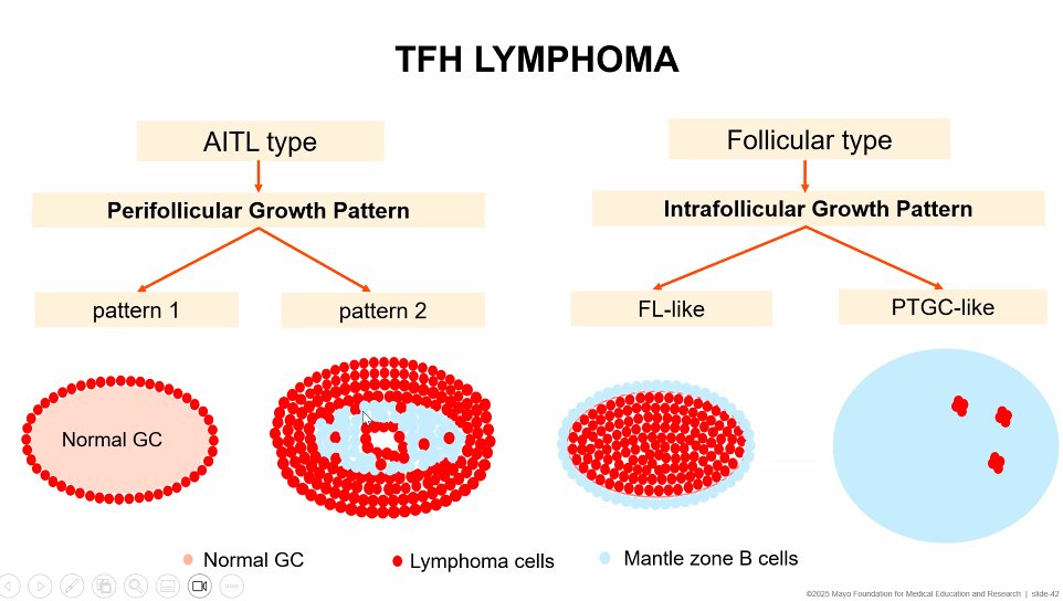Great cartoon by Dr. Min Shi today depicting the different types of infiltration by TFH lymphoma:

1) Peri-follicular (with patterns 1 and 2) 

2) Intra-follicular:

     a) FL-like, colonizing germinal centers 

or 

      b) PTGC-like with complete disruption of germinal