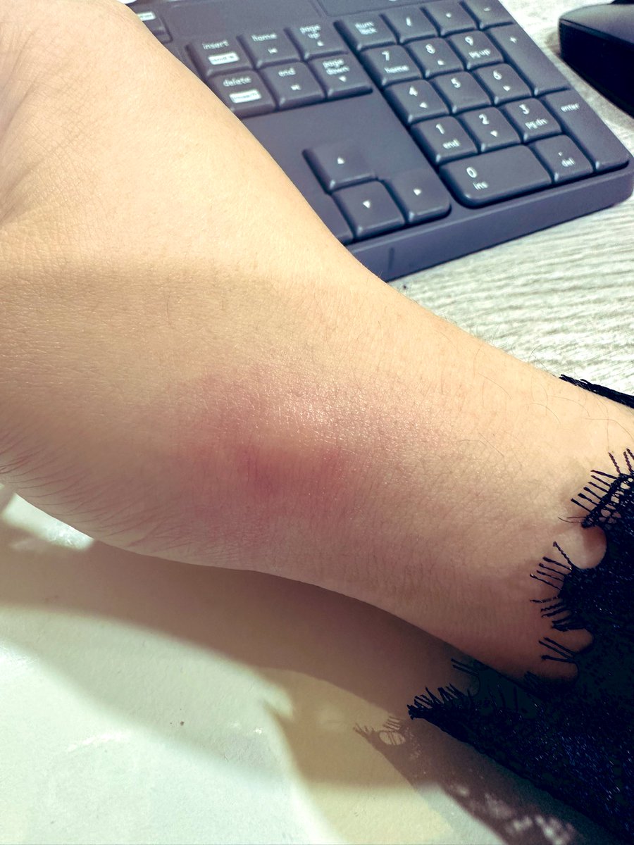 gina_Quo's tweet photo. 無情加班日！
還被叮了個大包🥹

突然好想吃蛋糕🍰

#台中 #肉肉女 #加班 #臭蚊子 https://t.co/U5hy8BoEMC