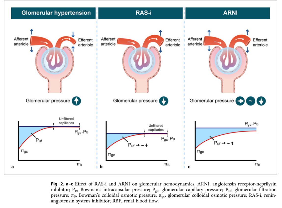 JonathanNefro's tweet photo. Beneficio renal de Sacubitril+valsartan

1. Dilata la arteriola aferente y eferente por natriuresis e inhibición de angiotensina II
3. ↓Hiperfiltración
4. Relaja la célula mesangial y aumentan el coeficiente de filtración glomerular

Kidney Blood Press Res 2024
10.1159/000541939 https://t.co/W9TRiiIz81
