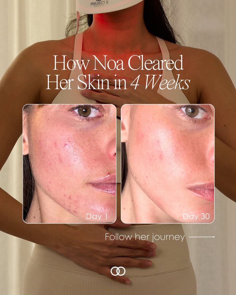 ProjectEBeauty's tweet photo. Noa's inspiring skin transformation has us reaching for our LED masks NOW 💖

Get clearer skin in just 4 weeks with the powerful LumaLux Face designed to clear and heal the skin while reversing signs of skin aging. Get yours for 10% off today with code RESTORE10 at checkout now https://t.co/ek2SFO7VE4