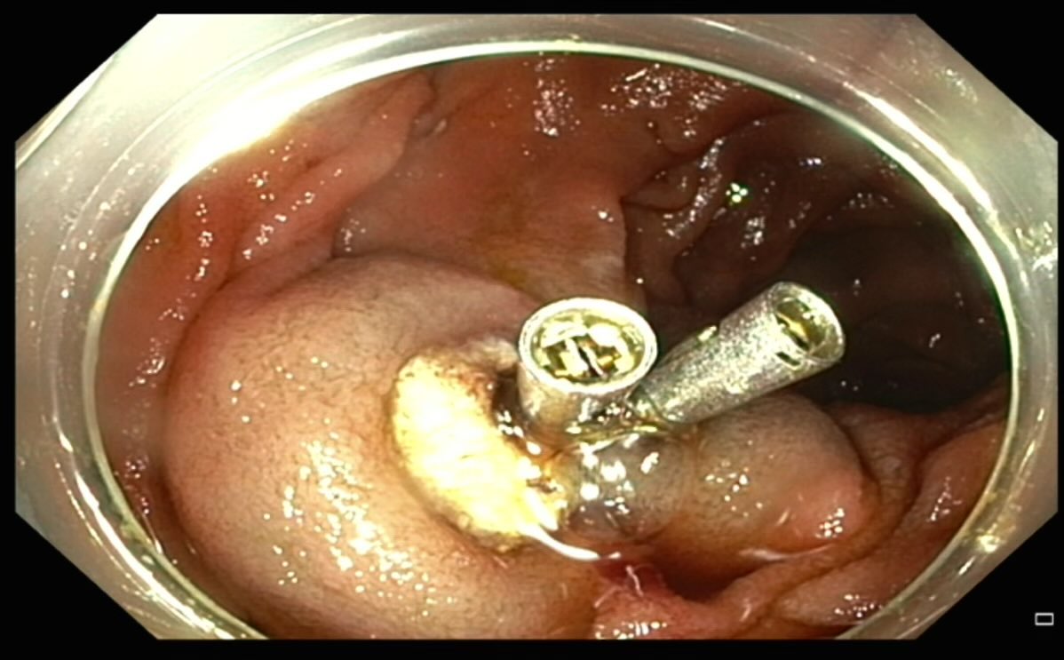 Ahmed Elfiky (@ahmed_elfiky) on Twitter photo Pt with Peutz-jeghers syndrome and history of small bowel polyps underwent push enteroscopy and EMR of 2 cm polyp in prox Jejunum. Path: hamaroma
<a href="/shandrawes/">Sherif Andrawes MD</a>
<a href="/NYSGE/">NYSGE</a> <a href="/AmCollegeGastro/">ACG</a> <a href="/ASGEendoscopy/">ASGE GI Endoscopy</a> <a href="/AGA_Gastro/">Gastroenterology</a> <a href="/FITE_endoscopy/">FITE - Foundation</a> <a href="/CrushingGIBoard/">CrushingGIBoards</a> Pt with Peutz-jeghers syndrome and history of small bowel polyps underwent push enteroscopy and EMR of 2 cm polyp in prox Jejunum. Path: hamaroma
<a href="/shandrawes/">Sherif Andrawes MD</a>
<a href="/NYSGE/">NYSGE</a> <a href="/AmCollegeGastro/">ACG</a> <a href="/ASGEendoscopy/">ASGE GI Endoscopy</a> <a href="/AGA_Gastro/">Gastroenterology</a> <a href="/FITE_endoscopy/">FITE - Foundation</a> <a href="/CrushingGIBoard/">CrushingGIBoards</a>