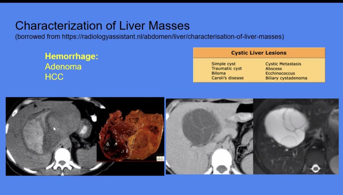 UMN Transplant Hepatology Fellowship (@umn_txhep) on Twitter photo Dr. Kyle Maurer <a href="/UMNRadiology/">U of MN Radiology</a> presenting for our weekly transplant hepatology didactics on liver imaging for hepatologists Dr. Kyle Maurer <a href="/UMNRadiology/">U of MN Radiology</a> presenting for our weekly transplant hepatology didactics on liver imaging for hepatologists
