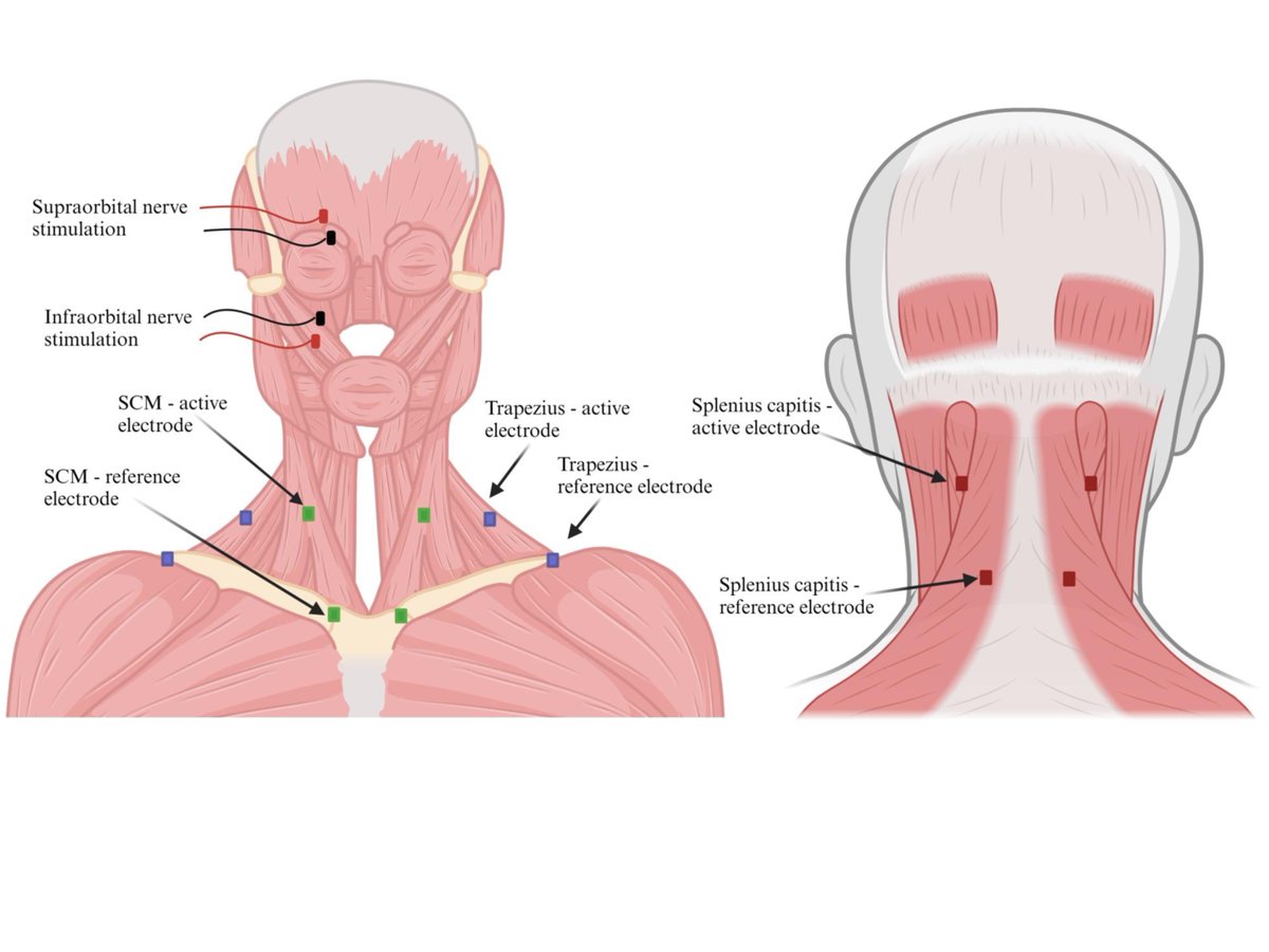 Journal of Clinical Neurophysiology (@jclinneurophys) on Twitter photo Melo et al recorded trigeminocervical reflex responses and found stimulating at 3 Hz produced reliable short-latency reflex components best in the ipsilateral sternocleidomastoid.  Read more here! ⚡bit.ly/3YhNAaB Melo et al recorded trigeminocervical reflex responses and found stimulating at 3 Hz produced reliable short-latency reflex components best in the ipsilateral sternocleidomastoid.  Read more here! ⚡bit.ly/3YhNAaB