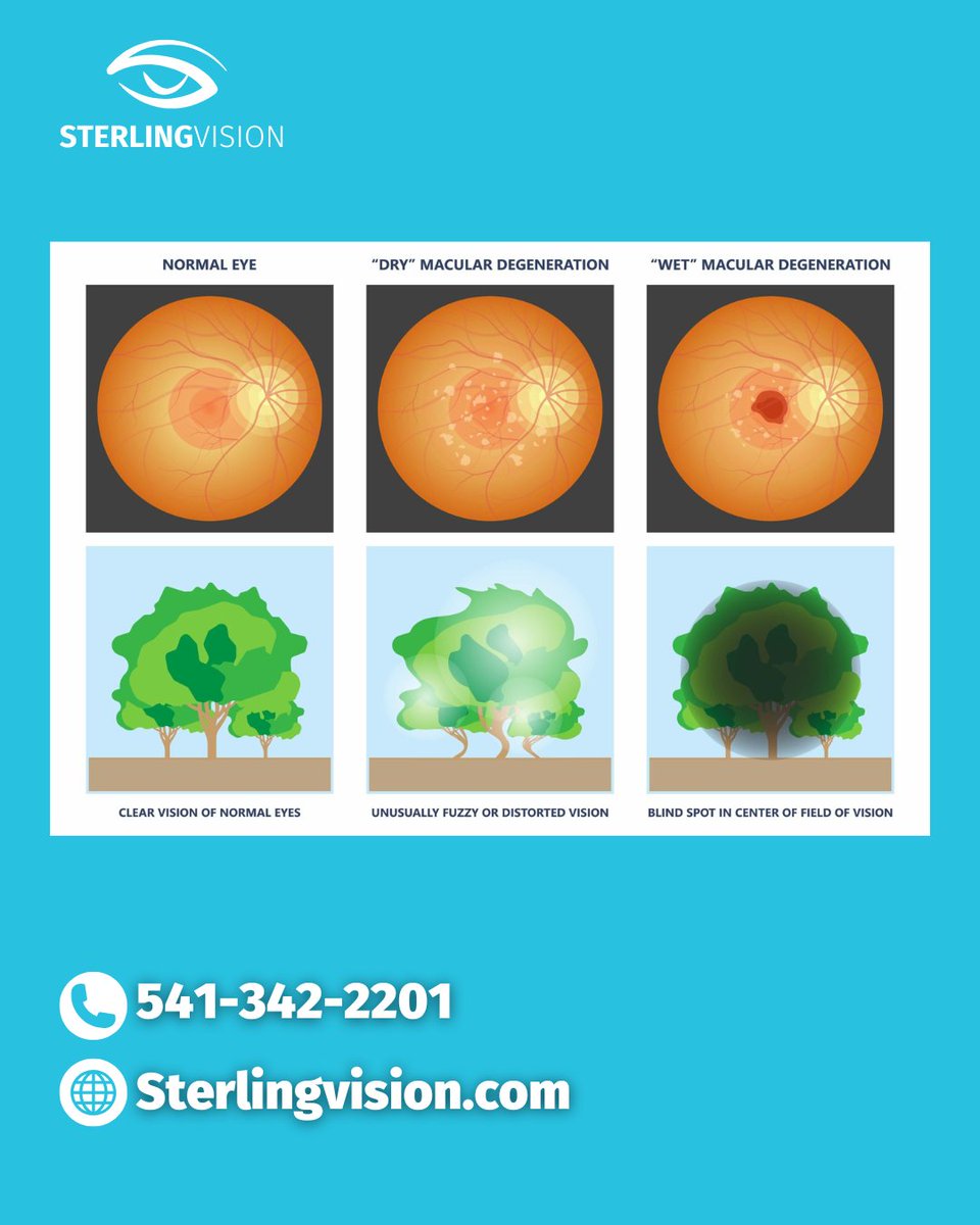 vision_sterling's tweet photo. What is Macular Degeneration? It affects your retina, impacting vision. Call 541-342-2201 or visit https://t.co/UxHXbWGn3k for an eye exam. #MacularDegeneration #AMDawareness #EyeHealthEugene https://t.co/vSh7d9LWYv