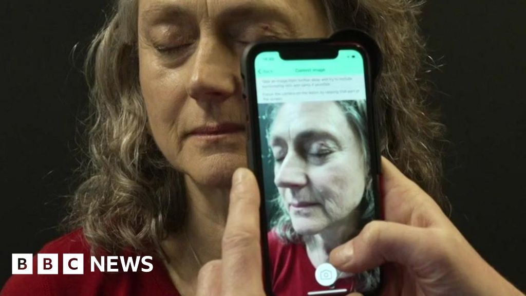 A worthwhile illustration of where the promise of AI + digital health is being translated into meaningful outcomes for patients. "The hospital gets about 7,000 urgent skin cancer referrals each year, but only 5% turn out to be cancer." buff.ly/JEtKEHK