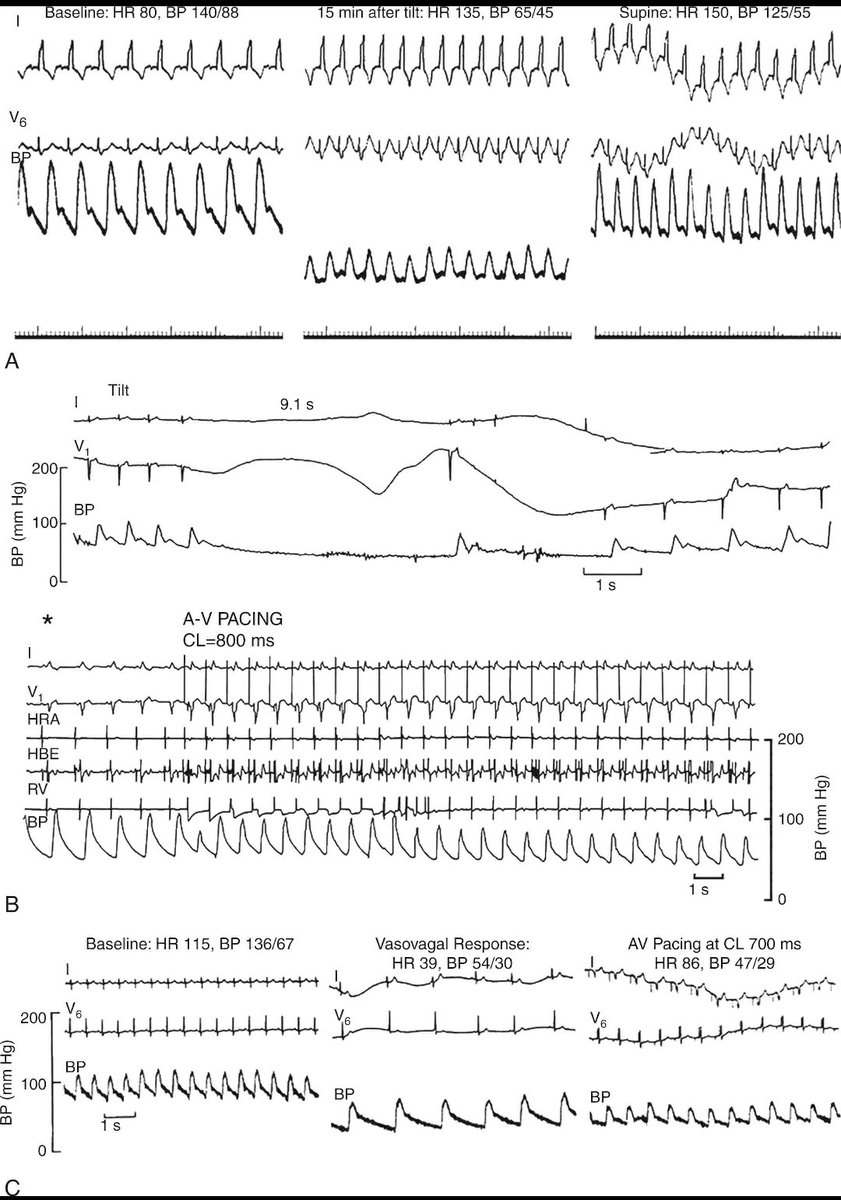 TrackYourHeart's tweet photo. Vasovagal response (neurocardiogenic syncope) is a reflex causing sudden bradycardia and/or vasodilation, leading to transient cerebral hypoperfusion and syncope.
Here are its three types:
(A) Vasodepressor – Significant ↓BP with normal HR
(B) Cardioinhibitory – ↓HR/asystole, BP normalizes with pacing
(C) Mixed – ↓HR + ↓BP, even with pacing support
Understanding the type is key to choosing the right management strategy.
Ref: Chen LY, Shen WK. Expert Opin Pharmacother. 2006;7:1151–1162.
#Cardiology #ECG #Syncope #MedTwitter #CathLab