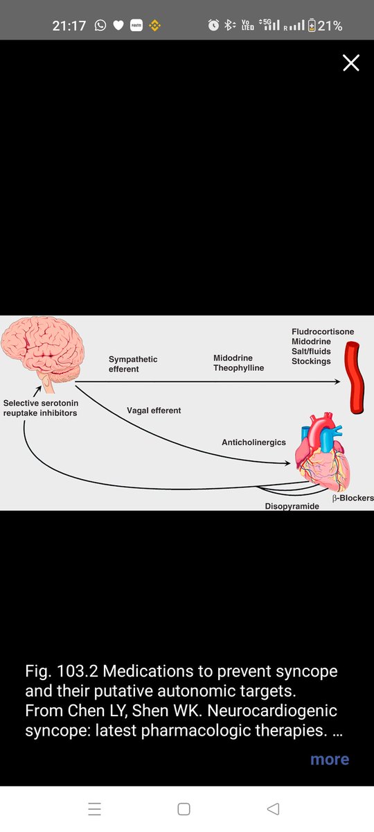 TrackYourHeart's tweet photo. Vasovagal response (neurocardiogenic syncope) is a reflex causing sudden bradycardia and/or vasodilation, leading to transient cerebral hypoperfusion and syncope.
Here are its three types:
(A) Vasodepressor – Significant ↓BP with normal HR
(B) Cardioinhibitory – ↓HR/asystole, BP normalizes with pacing
(C) Mixed – ↓HR + ↓BP, even with pacing support
Understanding the type is key to choosing the right management strategy.
Ref: Chen LY, Shen WK. Expert Opin Pharmacother. 2006;7:1151–1162.
#Cardiology #ECG #Syncope #MedTwitter #CathLab