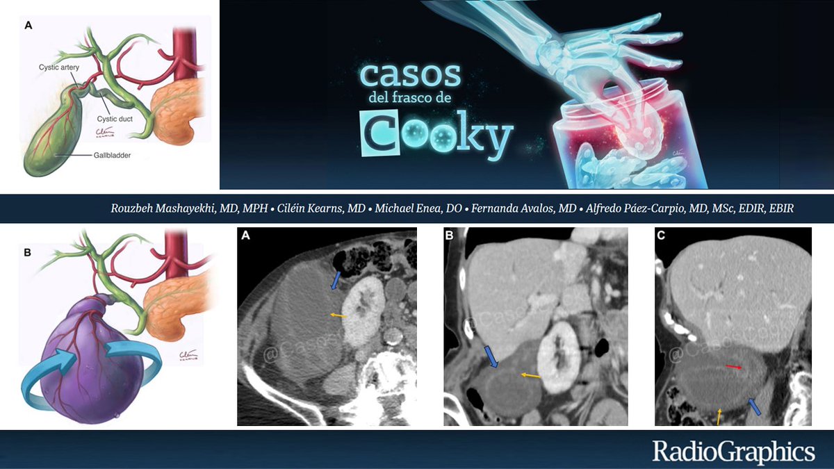 Casos de Cooky (@casoscooky) on Twitter photo Mujer de 84 años con vómitos y severo dolor abdominal.
¿Cuál es el diagnóstico?
Respuesta en 24h. Comparte casos complementarios con nosotros usando #CasosCooky #163 #CookyBites #RGphx <a href="/cookyscan1/">Cooky Menias</a>
<a href="/RadioGraphics/">RadioGraphics</a> Mujer de 84 años con vómitos y severo dolor abdominal.
¿Cuál es el diagnóstico?
Respuesta en 24h. Comparte casos complementarios con nosotros usando #CasosCooky #163 #CookyBites #RGphx <a href="/cookyscan1/">Cooky Menias</a>
<a href="/RadioGraphics/">RadioGraphics</a>