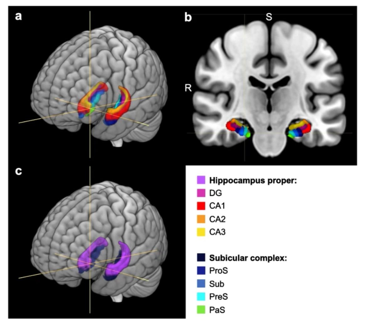 GeroScience (@geroscienceage) on Twitter photo 📢New Open🔓 Access Article in GeroScience
Bilingualism and “brain reserve” in subregions of the hippocampal formation by Katharina Peitz & Svenja Caspers (<a href="/LabCaspers/">Svenja Caspers</a>) et al.
rdcu.be/eh2jx
#aging #bilingualism #hippocampus #graymatter #brain 📢New Open🔓 Access Article in GeroScience
Bilingualism and “brain reserve” in subregions of the hippocampal formation by Katharina Peitz & Svenja Caspers (<a href="/LabCaspers/">Svenja Caspers</a>) et al.
rdcu.be/eh2jx
#aging #bilingualism #hippocampus #graymatter #brain