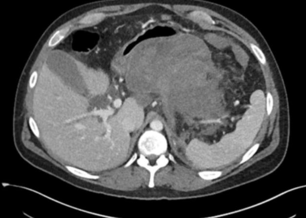Trauma Surgery & Acute Care Open (TSACO) (@tsaco_aast) on Twitter photo More Mattox content <a href="/TCCACS/">Mattox/Vegas TCCACS</a> #TCCACS2025
"Managing complicated pancreatitis with more knowledge and a bigger toolbox"
➡️ bit.ly/3Rlubly More Mattox content <a href="/TCCACS/">Mattox/Vegas TCCACS</a> #TCCACS2025
"Managing complicated pancreatitis with more knowledge and a bigger toolbox"
➡️ bit.ly/3Rlubly