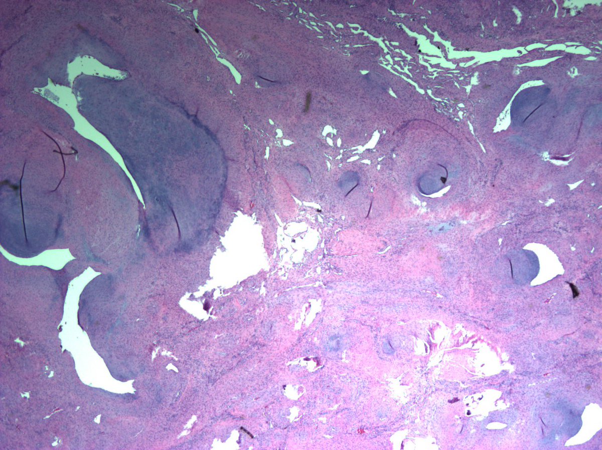 56 year old, left wrist mass. Diagnosis?