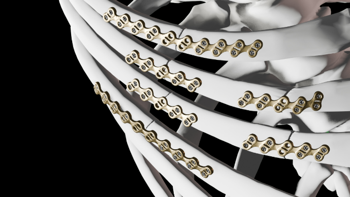 CWISociety's tweet photo. 🚨 There’s more than one way to fix a rib. 🚨
Have you seen L1 Rib – PEEK in action? As a non-metallic alternative to traditional plating, it's changing the conversation around rib fixation.
📍Stop by the KLS Martin booth to learn more.
#KLSMartinGroup #CWIS25 #L1RibPEEK https://t.co/2Intwxwe3V