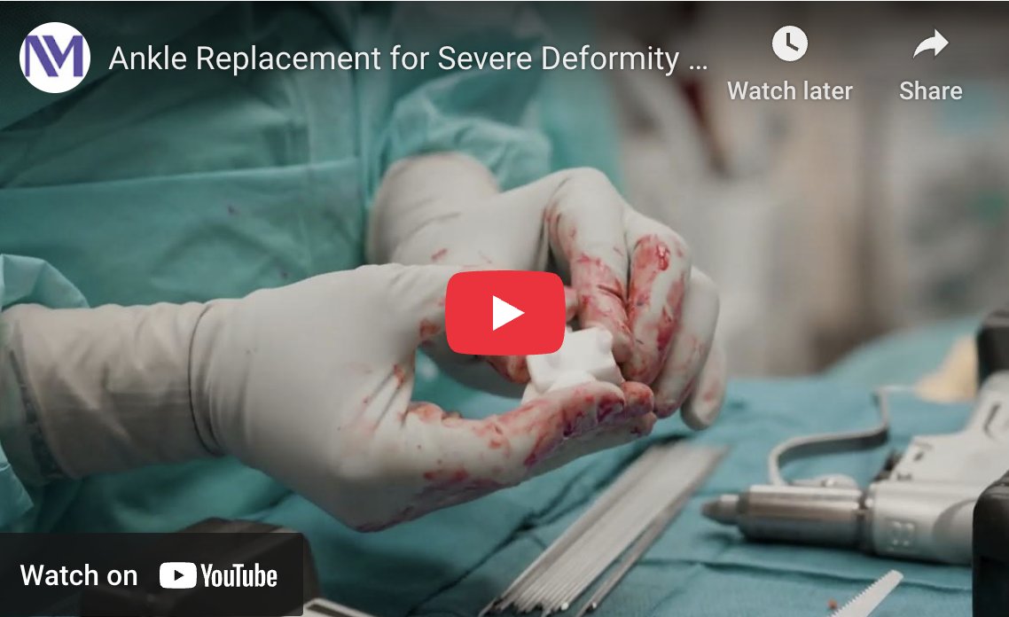 Step into the OR with Anish Kadakia, MD, as he performs a complex #AnkleReplacement surgery on a patient with severe ankle #arthritis and deformity due to chronic instability and ligament erosion. Watch now:
breakthroughsforphysicians.nm.org/orthopaedics-c…