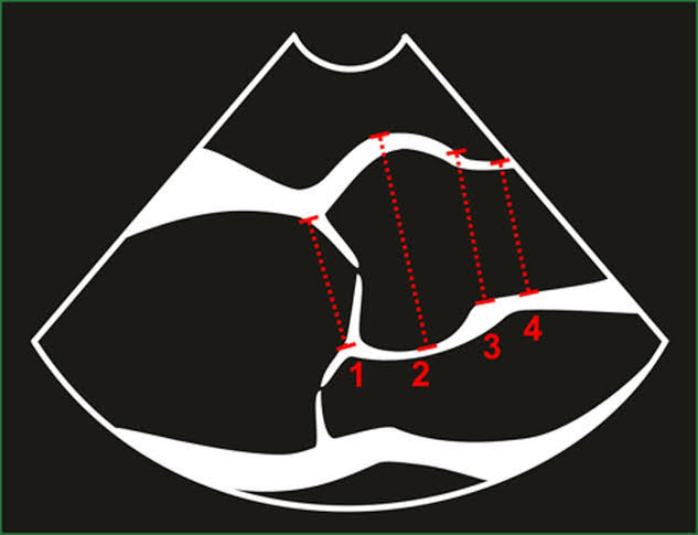 drahmedmohsen85's tweet photo. How to measure the aorta by Echocardiography?
Check the first comment https://t.co/KRYfSIjpgo