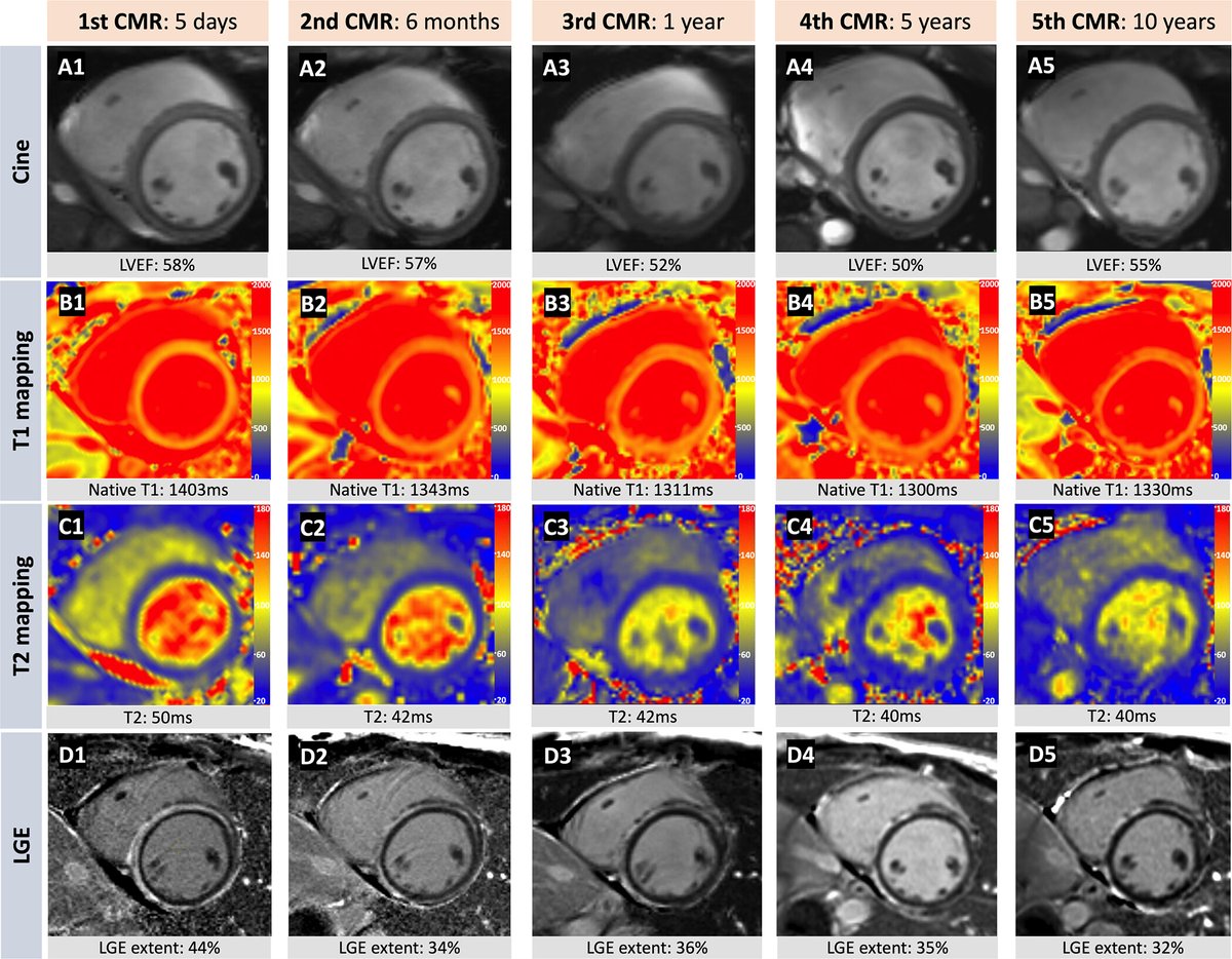 Drs. Li and Chen present this interesting cardiac MRI case of myocarditis over the course of a decade in this week's Images in Radiology. bit.ly/42BJcVu