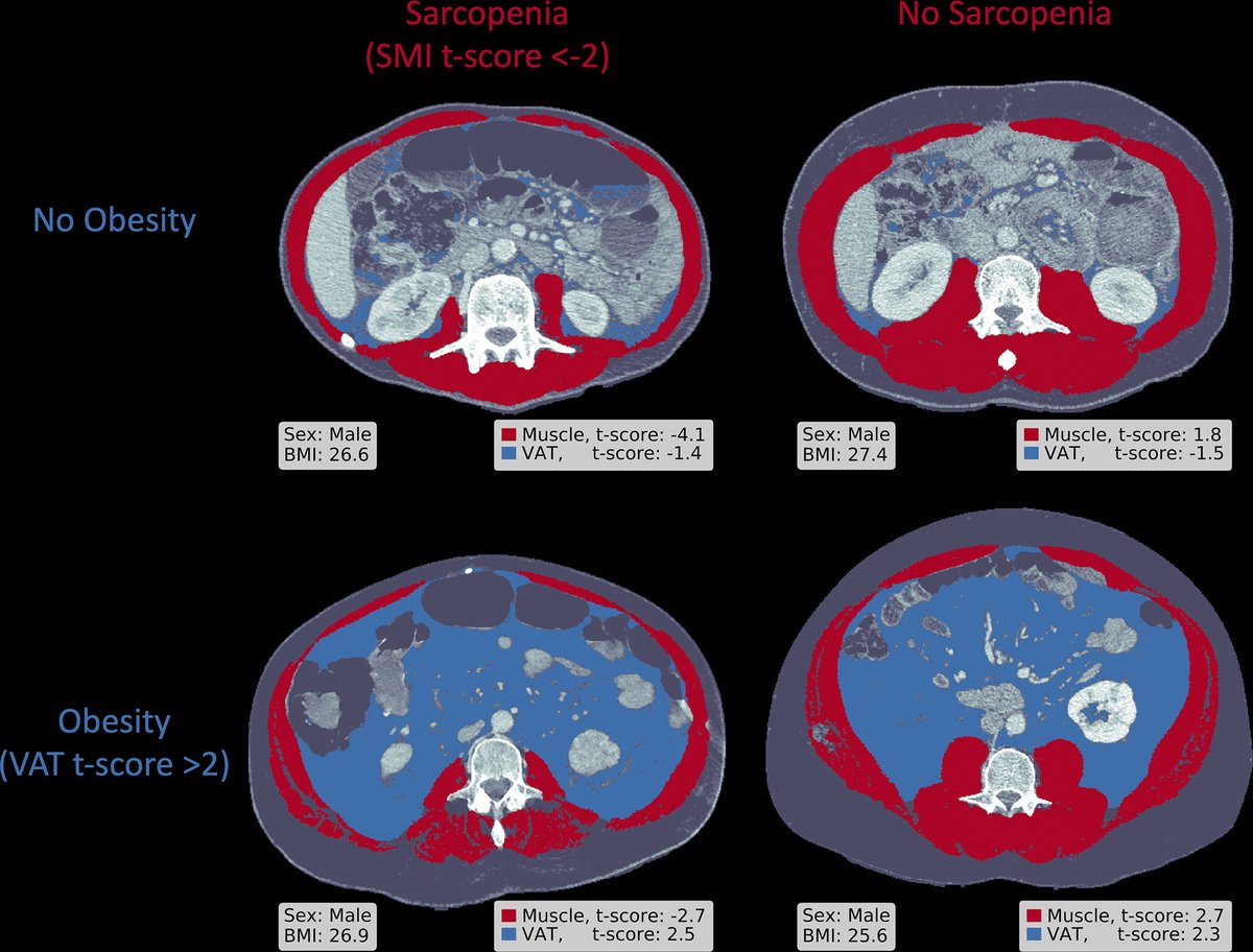 Zambrano Chaves et al share their results from their retrospective audit of the EHR documentation of the terms sarcopenia, obesity, and sarcopenic obesity across 275 institutions and compared them with CT scan assessments of the same. bit.ly/3XYYT7D