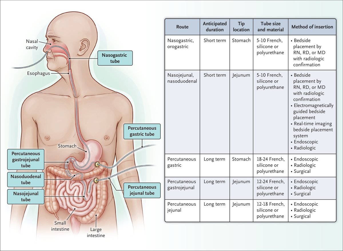 Enteral Nutrition in Hospitalized Adults. nejm.org/doi/full/10.10… 
This review considers enteral nutrition in the context of disease-related malnutrition, provides evidence for the use of enteral nutrition in hospitalized patients, and discusses practice considerations.