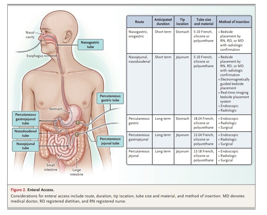 Nutrición enteral en adultos hospitalizados

Revisión de <a href="/NEJM/">NEJM</a>