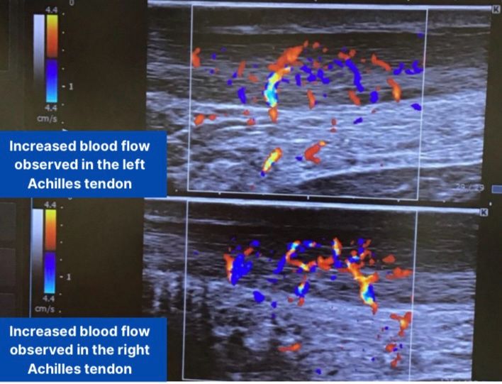 YujiOkuno_OC's tweet photo. Achilles tendinopathy unresponsive to PRP improved dramatically after two arterial infusion sessions, with pain decreasing from 8 to 1–2 out of 10, and a return to running. This case highlights the effectiveness of targeting abnormal neovessels with arterial infusion therapy. https://t.co/mn2Qj16Li0