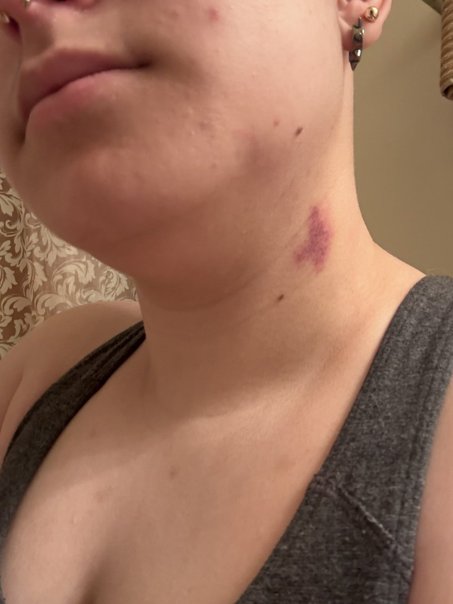 TigressNS's tweet photo. Got work tomorrow...... 😅
Think I can pass it off as a bruise? 🤭😅🤣😭 https://t.co/3ZOFYXP2JJ