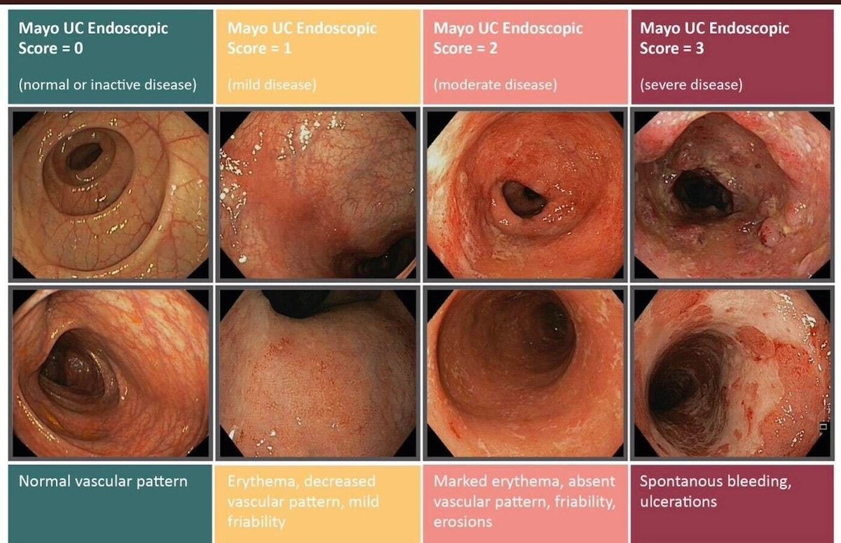 Mayo Score for Ulcerative Colitis