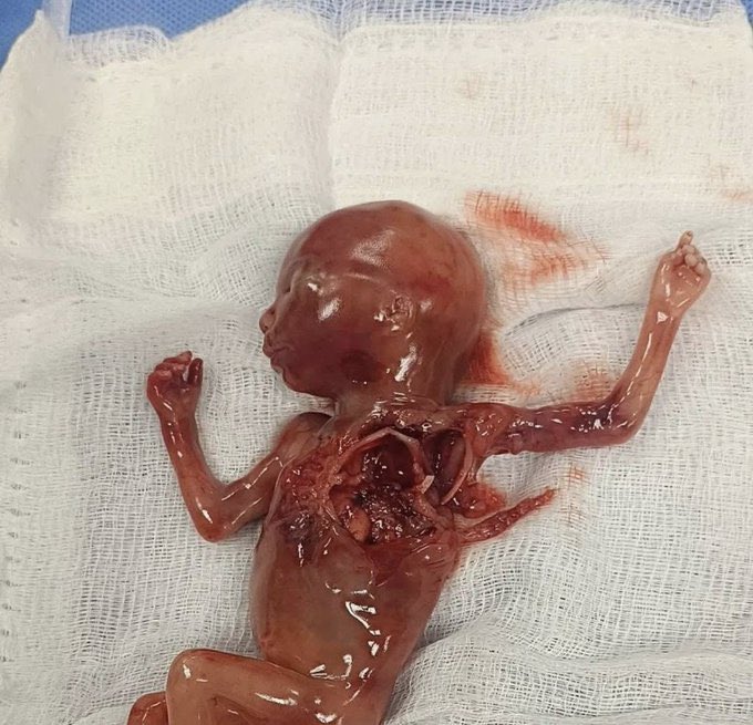 Unborn terrorist according to Israeli criteria.. He was KILLED along with his mother in Israeli bombing of their tent in Gaza!