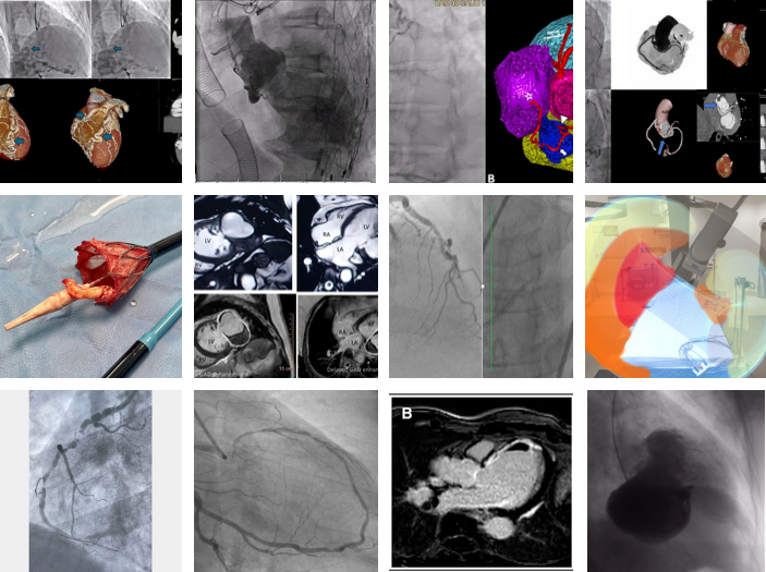 PCRonline 🫀 (@pcronline) on Twitter photo An image 🖼️ is worth a 1,000 words... and a #EuroPCR image even more!
🔗pcronline.com/Cases-resource…
View these interesting and puzzling images selected for EuroPCR 2025. Don't forget to comment by telling us what you see, and do share them via social media using the hashtag An image 🖼️ is worth a 1,000 words... and a #EuroPCR image even more!
🔗pcronline.com/Cases-resource…
View these interesting and puzzling images selected for EuroPCR 2025. Don't forget to comment by telling us what you see, and do share them via social media using the hashtag