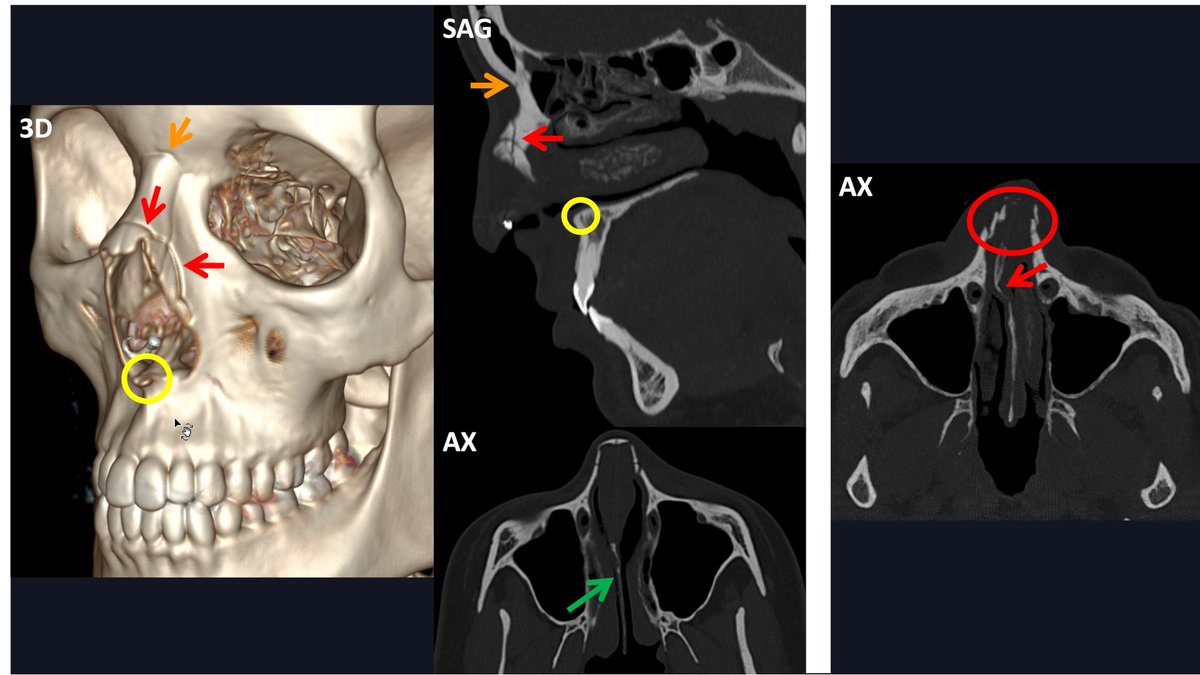 Imaging of facial fractures is challenging, but #ctscan can provide a path to diagnosis in polytraumatic or unconscious patients and in cases of severe soft tissue lesions. auntminnieeurope.com/clinical-news/… #radiology #HNRad #NIRADS #HeadandNeck