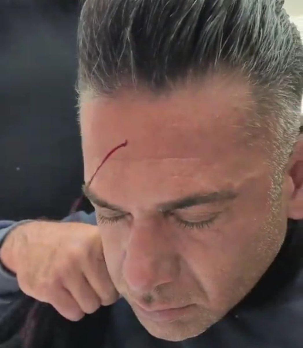 FaresOmarii's tweet image. انتشرت فيديوهات ما قبل فترة لطريقة علاج شعبية تقوم على قطع شريان في الجبهة وجعل الدم يتطاير ويقولون انها علاج للشقيقة والام الرأس وغيرها .. فما اسم هذا العلاج التقليدي وما حقيقته

تابع