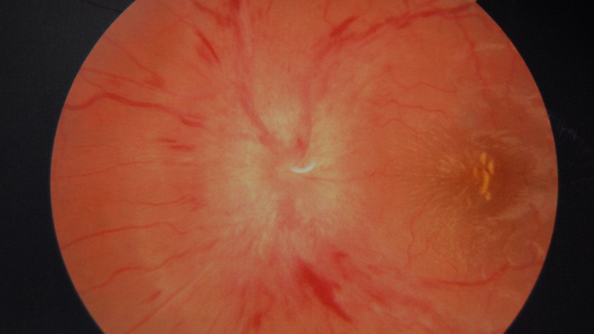 Practical Neurology (@practicalneurol) on Twitter photo Precision communicating clinical findings #healthcare is essential. #Papilleodema is bilateral optic nerve disc oedema secondary to raised ICP.<a href="/UKNOSoc/">UKNOSoc</a> <a href="/ABNTrainees/">Neurology Trainees</a> <a href="/NANSIG1/">NANSIG (Neurology and Neurosurgery Interest Group)</a> <a href="/NANOSTweets/">NANOS</a> <a href="/EunoSsociety/">EUNOSsociety</a> Precision communicating clinical findings #healthcare is essential. #Papilleodema is bilateral optic nerve disc oedema secondary to raised ICP.<a href="/UKNOSoc/">UKNOSoc</a> <a href="/ABNTrainees/">Neurology Trainees</a> <a href="/NANSIG1/">NANSIG (Neurology and Neurosurgery Interest Group)</a> <a href="/NANOSTweets/">NANOS</a> <a href="/EunoSsociety/">EUNOSsociety</a>