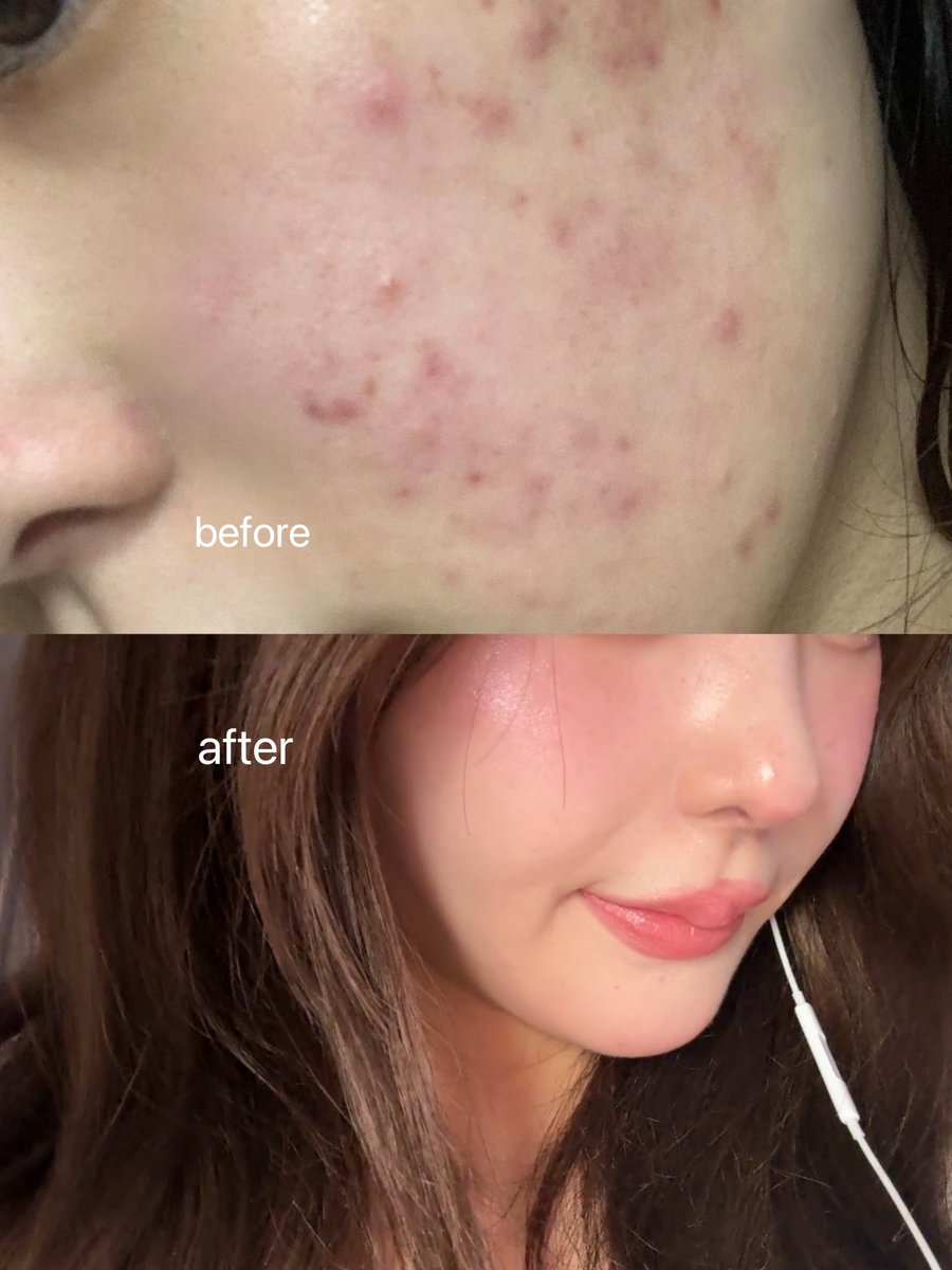aoaoakari00's tweet photo. ほんとに気をつけないとすぐ荒れちゃう
肌タイプの私が最近ずっと
調子がいいので
使ってるスキンケア達

リアルに紹介しますううう！！！

ほんとに今褒められるほんと
2枚目無加工です！！
肌荒れしてると
素肌も赤くなってしまうの

今はトラブル全くなくてトーンアップ
してくれてるくらいほんとに幸せ噛み締めてる荒れませんように！！！