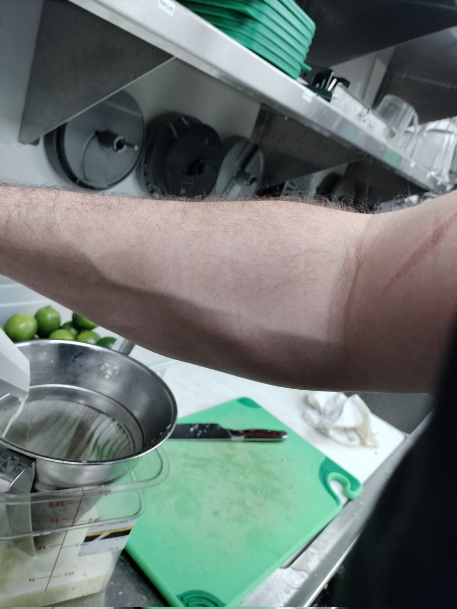 BiRadiance's tweet image. Bakers arms, burns and veins.