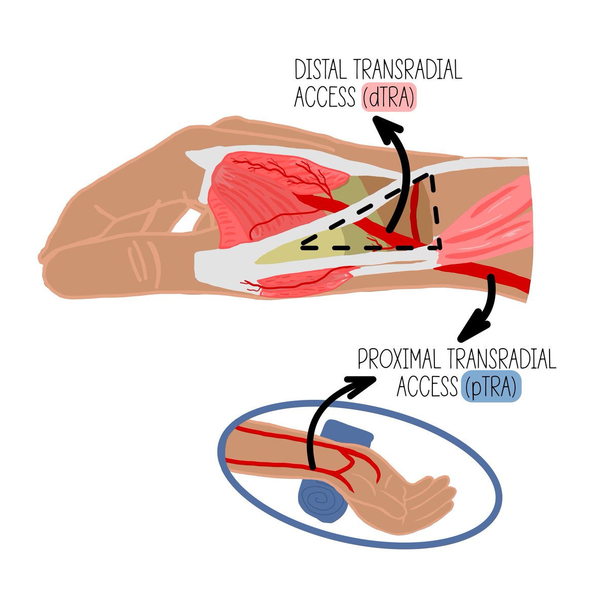 Journal of Invasive Cardiology (@invasivecardiol) on Twitter photo April Feature: Ultra-Low Contrast Strategy for Routine Coronary Procedures via Distal Transradial Access ➡️ hubs.ly/Q03hjHwF0
<a href="/DLBHATTMD/">Dr. Deepak L. Bhatt</a> #cardioTwitter #cardioX #cardiology #interventionalcardiology April Feature: Ultra-Low Contrast Strategy for Routine Coronary Procedures via Distal Transradial Access ➡️ hubs.ly/Q03hjHwF0
<a href="/DLBHATTMD/">Dr. Deepak L. Bhatt</a> #cardioTwitter #cardioX #cardiology #interventionalcardiology