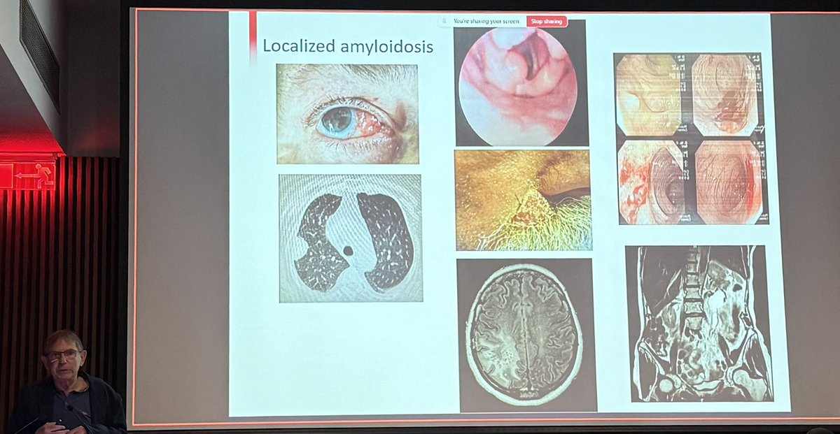 اشكر للزملاء اتاحتي فرصة المشاركة في المؤتمر السعودي الأول في الداء النشواني بمستشفى الملك فيصل التخصصي بالرياض، شارك فيه نخبة من خبراء العالم من ارقى الجامعات لمناقشة الابعاد المختلفة لهذا المرض الخطير