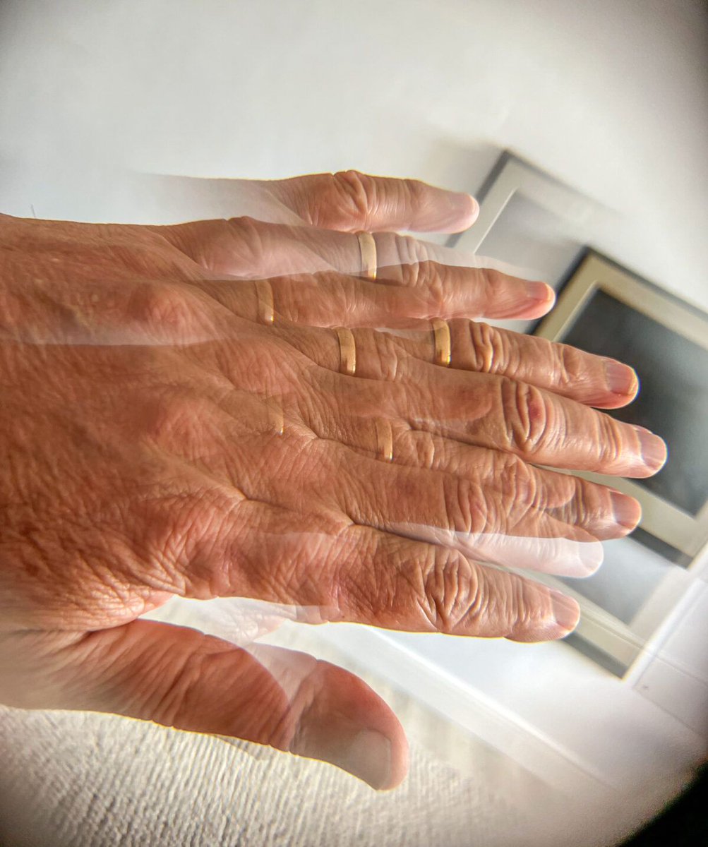 pcacares_org's tweet image. April is #ParkinsonsAwarenessMonth. 10M+ people live with Parkinson’s worldwide. Symptoms include tremors, stiffness, balance issues &amp;amp; more. Though there’s no cure, treatment can help. #PDawareness #Parkinsons buff.ly/tygfAtr