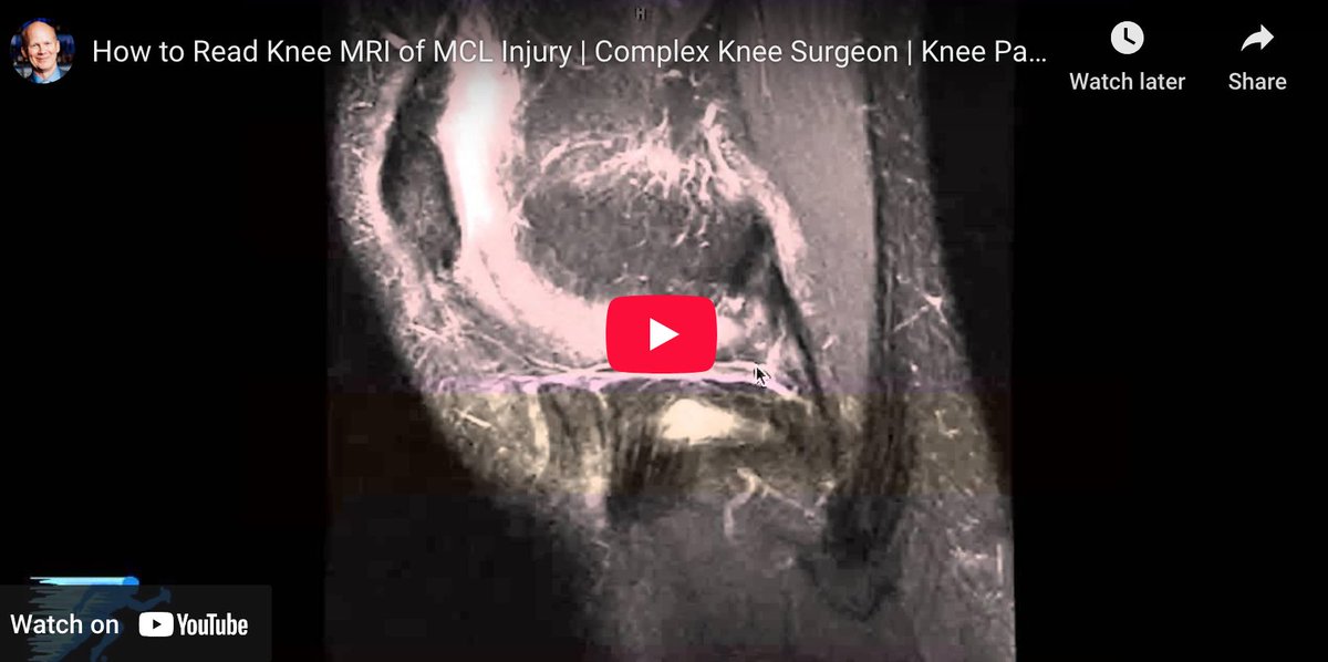 Here’s What an MRI Tells Us About MCL Tears: Dr LaPrade explains how to read an #MRI of an #MCLinjury from a #skiing accident. Whether you’re an athlete or weekend warrior, understanding your MRI results can make all the difference in recovery! medilink.us/7v0r #medtwitter