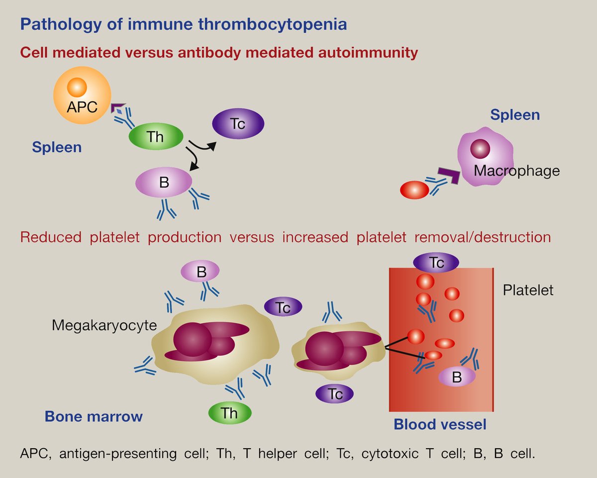 Thrombocytopenia - this review article in the April issue of Medicine discusses the causes of thrombocytopenia with a focus on Immune thrombocytopenia
sciencedirect.com/science/articl…
<a href="/AlbertF001/">Albert Ferro</a> 
@DeeptiRadia 
<a href="/doctoruprichard/">James Uprichard💙</a> 
#MRCP #MedEd #PLAB