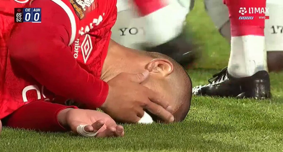 #Deportes l El delantero colombiano Yorleys Mena le propinó un tremendo codazo a Danilo Ortíz que tendrá una  doble cirugía maxilar  por fractura y la pérdida de 3 piezas dentales y para colmo ¡FUE SÓLO AMARILLA habiendo VAR!