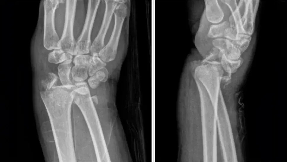 Cleveland Clinic MD (@cleclinicmd) on Twitter photo Treatment for wrist fractures depends on the nature and severity of injury. A hand and wrist surgeon explains the variations: cle.clinic/3WXz3k0 Treatment for wrist fractures depends on the nature and severity of injury. A hand and wrist surgeon explains the variations: cle.clinic/3WXz3k0