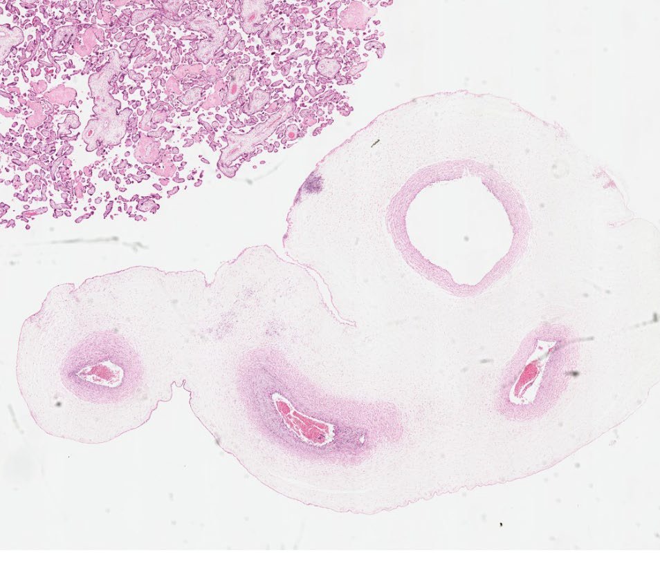 Path4People's tweet image. Newborn Infant 👶 

Fever, Irritability, and elevated WBC

Umbilical cord surface demonstrates small yellow plaques

Dx?

📸 Credit: Robert O Brady, MD

#pathx #pedipath #obgyn #peds