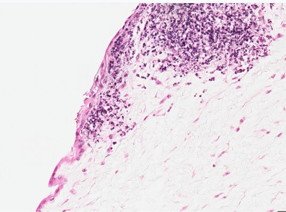 Newborn Infant 👶 

Fever, Irritability, and elevated WBC

Umbilical cord surface demonstrates small yellow plaques

Dx?

📸 Credit: Robert O Brady, MD

#pathx #pedipath #obgyn #peds