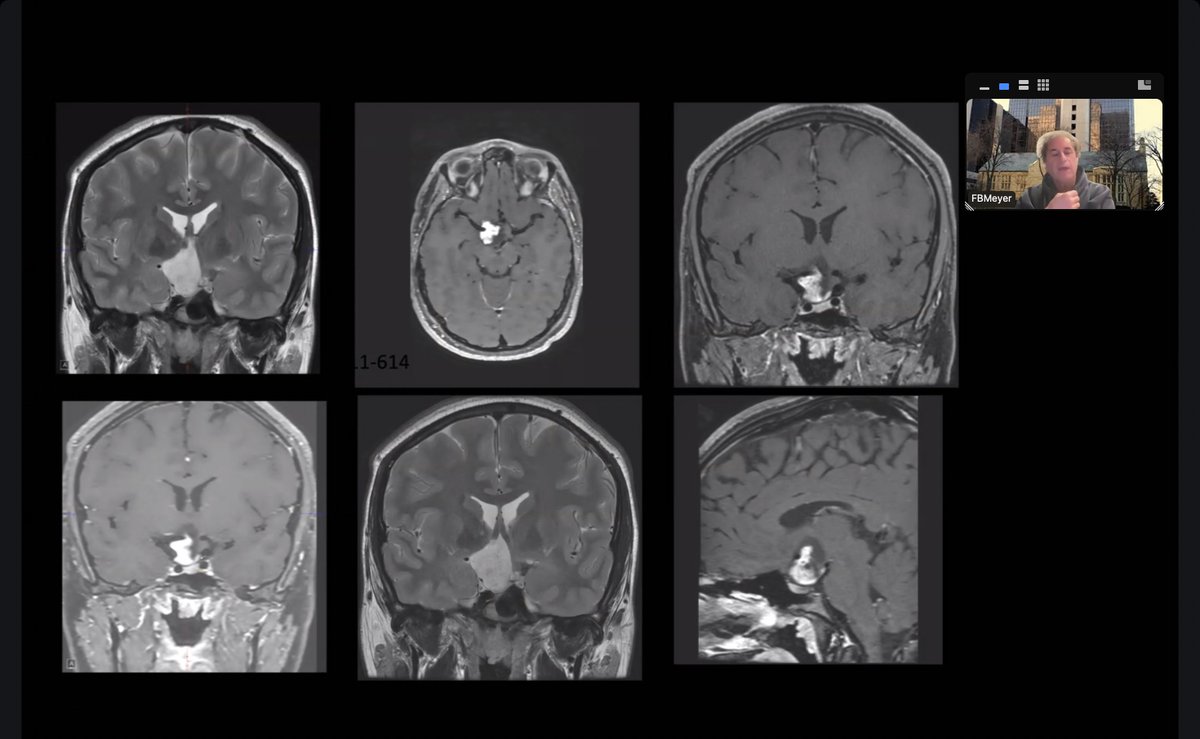 Another successful semester of Journal Club! 👏🧠 Shoutout to David Eke, Mohammed Sawi &amp; Devonte Sobamowo for awesome presentations on studies in vestibular schwannomas, ventriculostomy &amp; craniopharyngiomas. #MedEd #Neurosurgery