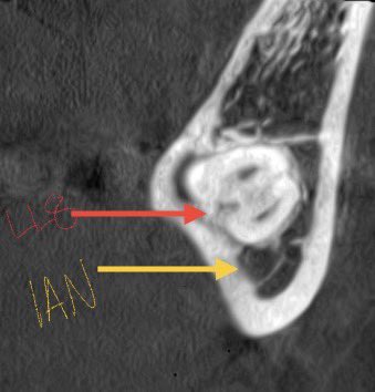 BAOS_UK's tweet photo. Coronectomy! 

A procedure to remove the crown of an impacted tooth to prevent pathology, such as pericoronitis, whilst leaving the roots in place 🦷 This is often undertaken when there is an increased risk of damage to local anatomical structures, most often the inferior alveolar nerve ⚡️

In this case the LL8 underwent coronectomy due to features indicative of increased risk of inferior alveolar nerve damage on an OPG and cone-beam CT, including deviation and loss of upper cortical outline of the canal 

During a follow-up radiograph to further assess the LR8 due to ongoing symptoms, you can see there is some root migration away from the nerve on the LL8 roots! 

#OralSurgery #Dentist #Dentistry #BAOSUK #OMFS #Surgery #Teeth #Teaching #Learning #clinicaleducation #MedicalEducation