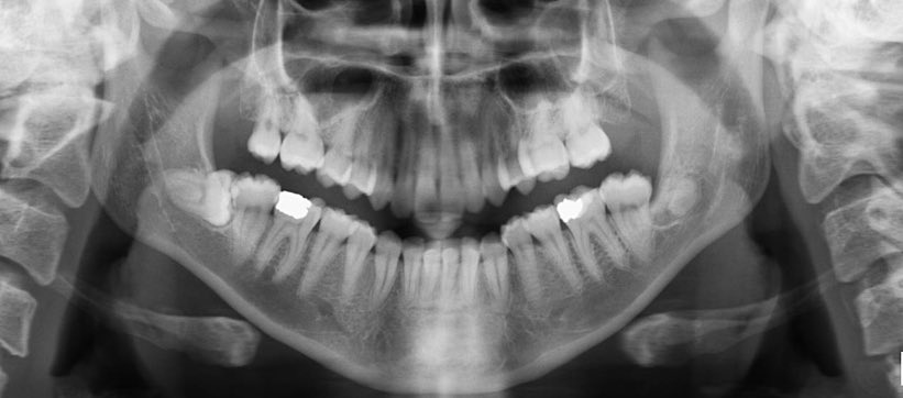Coronectomy! 

A procedure to remove the crown of an impacted tooth to prevent pathology, such as pericoronitis, whilst leaving the roots in place 🦷 This is often undertaken when there is an increased risk of damage to local anatomical structures, most often the inferior
