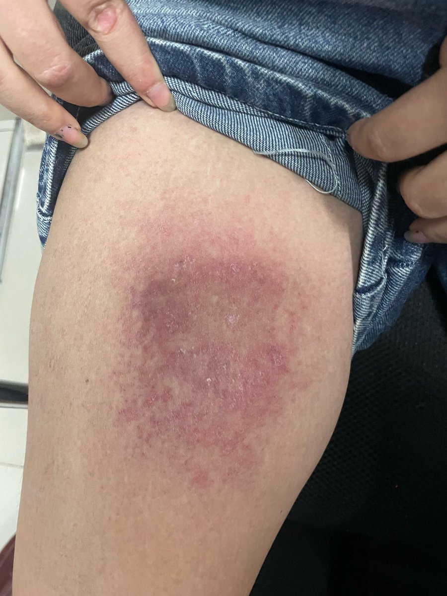 ConsejosReumato's tweet photo. Mujer con #dermatomiositis quien presenta afección de #piel , vean #rash en muslo, cara posterior del cuello y parte superior de #espalda , así como en cara anterior del tórax. #skin #myositis #skinrash #dermatomyositis #ck #muscle #myopathy #Weakness #gottron #heliotrope https://t.co/C8lCp6bVFF