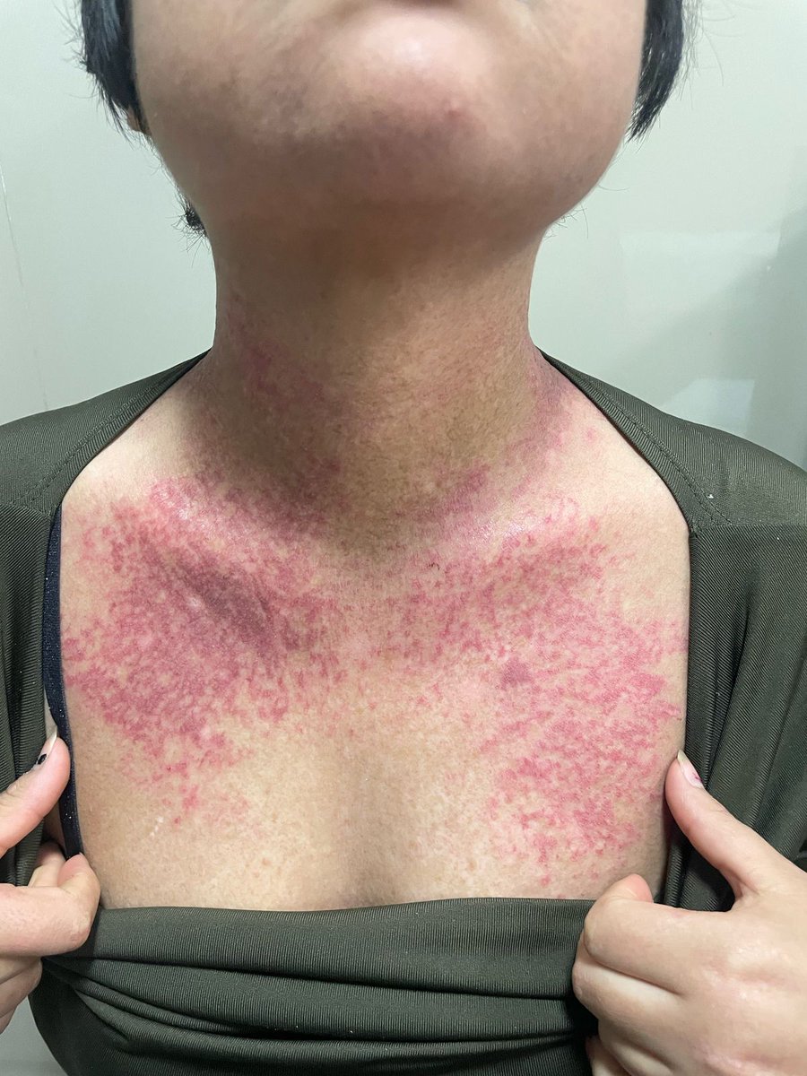 ConsejosReumato's tweet photo. Mujer con #dermatomiositis quien presenta afección de #piel , vean #rash en muslo, cara posterior del cuello y parte superior de #espalda , así como en cara anterior del tórax. #skin #myositis #skinrash #dermatomyositis #ck #muscle #myopathy #Weakness #gottron #heliotrope https://t.co/C8lCp6bVFF