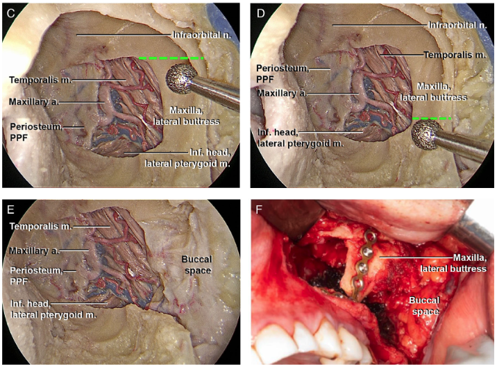 Triological's tweet photo. Infratemporal fossa surgery is challenging and fairly morbid, especially for large tumors. This #free video #howidoit surgery article drills down the basic steps.
https://t.co/bAupEuWz3g
#skullbasesurgery #headnecksurgery #headneckcancer #beatcancer #ENTsurgery #Triological https://t.co/CHI9wAdIEq