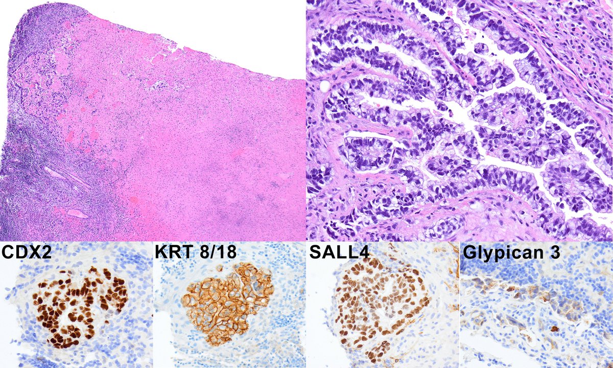 Enteric yolk sac tumor
This extensively necrotic anterior abdominal mass shows positive CDX2, KRT8/18, and SALL4, all features identical to enteroblastic Ca. If enteric type yolk sac tumor presents as a metastasis of unknown origin, only isochromosome 12p testing tells the truth.